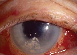 Corticosteroid induced cataract