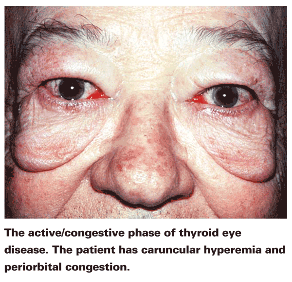 Ocular Hypertension: 5 Causes of High Eye Pressure