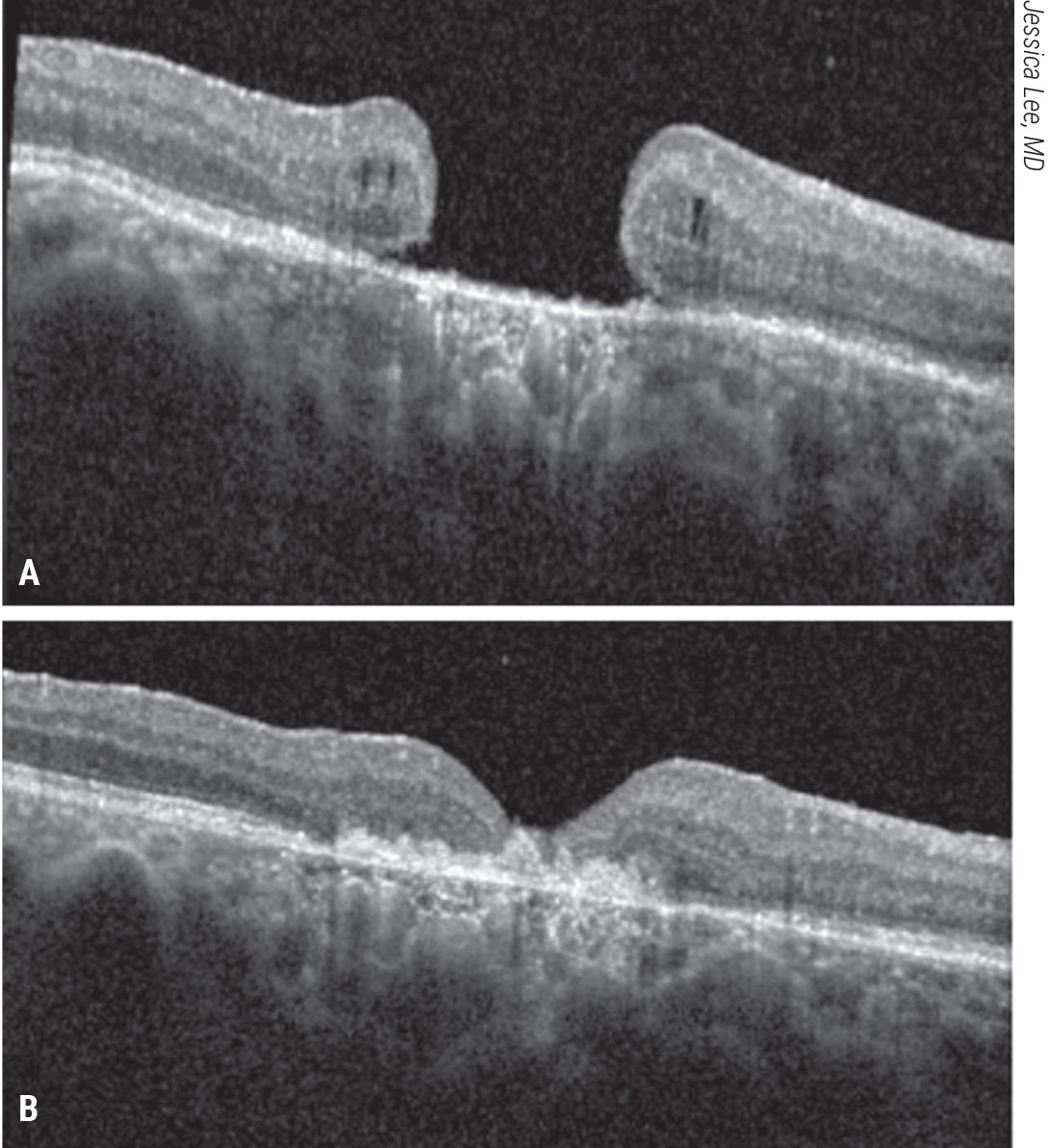Figure 9. Subretinal human amniotic membrane for a refractory macular hole. A patient with count-fingers vision presented with a refractory macular hole after prior vitrectomy, ILM peeling and gas tamponade. A human amniotic membrane graft was placed in a subretinal position followed by gas tamponade. The patient’s macular hole closed and visual acuity improved to 20/200 (B). 