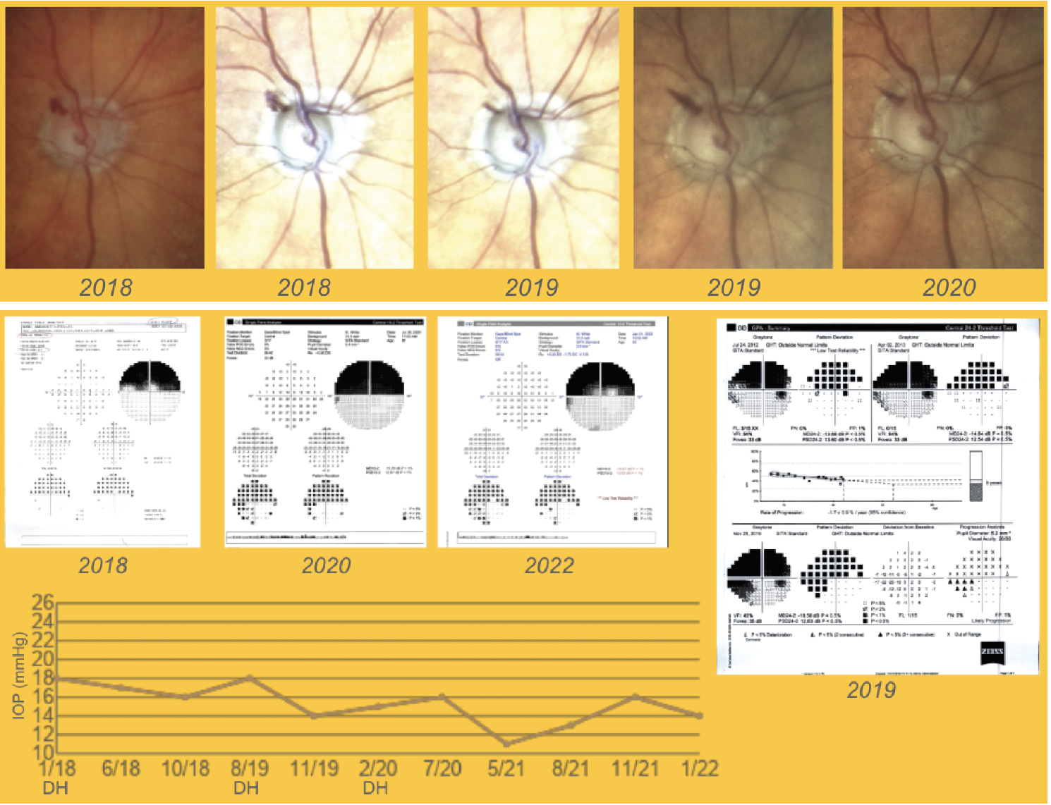 Figure 3. A patient in her 80s developed several disc hemorrhages over a two-year period in the superotemporal area (Case #2). Surgery was recommended, but the patient preferred to use maximal medical therapy, which was adjusted to further decrease IOP, and has remained stable. Some inferonasal spots were seen on the 2020 10-2 visual fields but IOP remained overall stable.