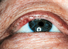 Management Of Eyelid Malignancies