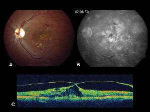 retinal edema chronic