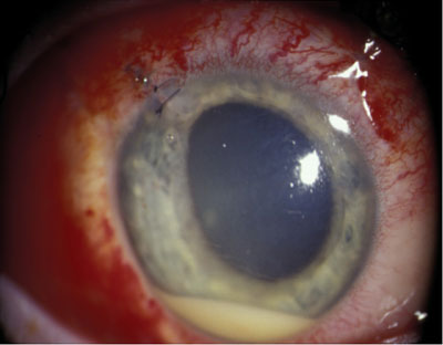 swelling in retina after cataract surgery