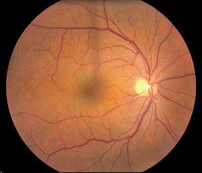 macular oedema after cataract surgery)