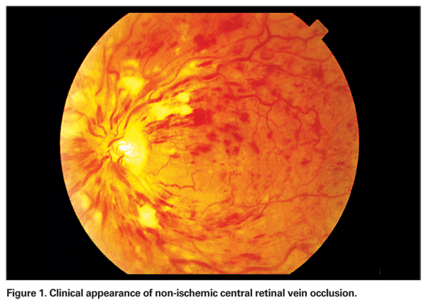 Retinal vascular occlusion