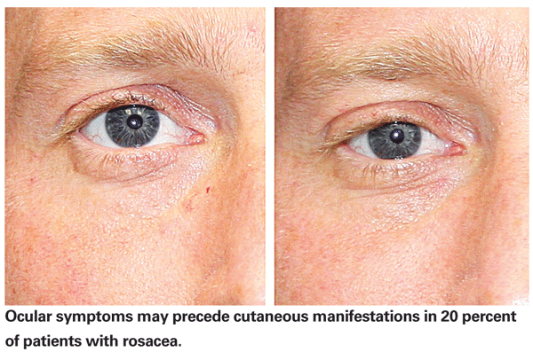 What are some treatments for ocular rosacea?