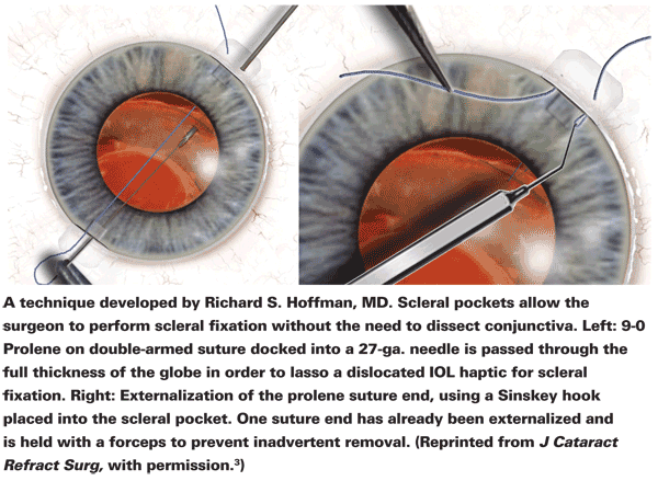 Dislocated Soemmering Ring in a Myopic Eye