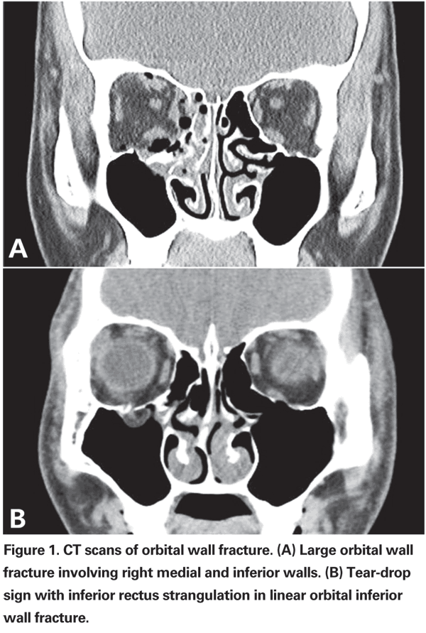 Diagnosis And Treatment Of Orbital Fractures