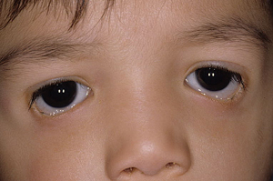 The Genetic Basis Of Oculoplastic Disorders