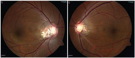 myopia glaucoma emberi test látása