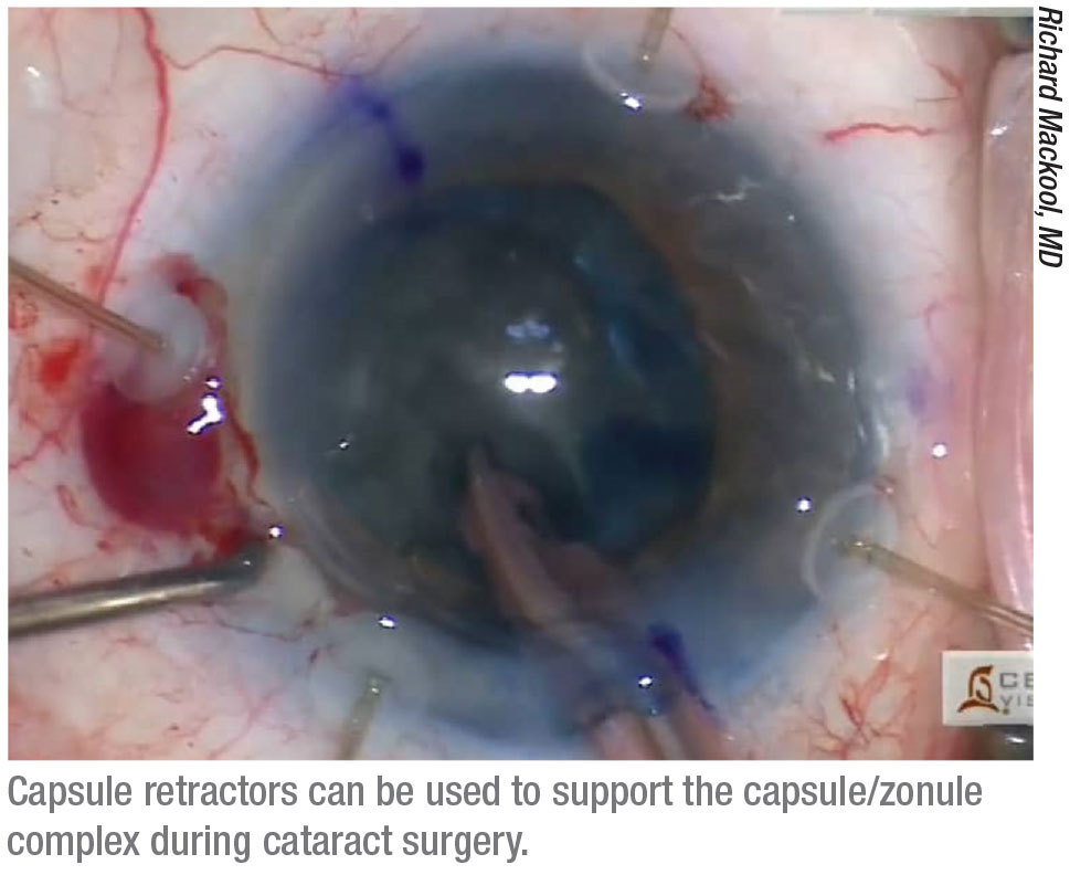 Insertion of a Malyugin ring to facilitate cataract surgery in a patient  with Intraoperative Floppy Iris Syndrome. | By Scott W. Tunis MD FACS |  Facebook