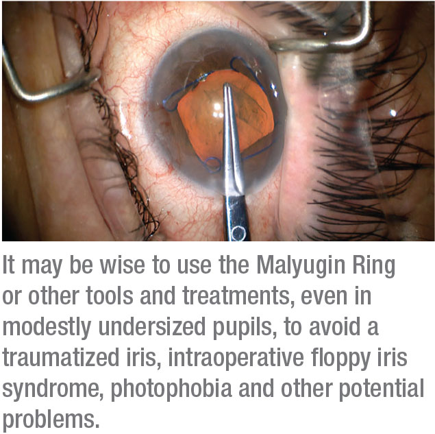 Making a Case: Iris Hooks vs. Malyugin Ring | by MicroSurgical Technology —  MST | Medium