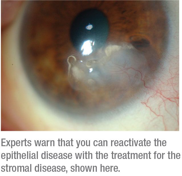 herpes simplex ocular tratament)