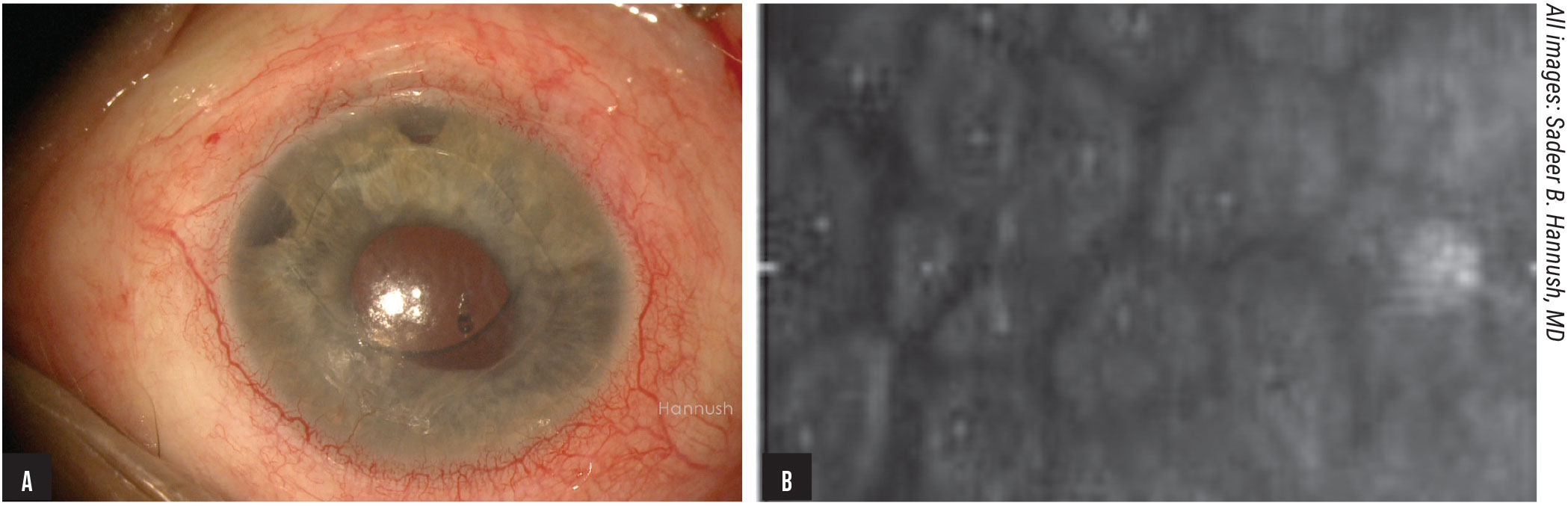 Figure 1. Ovalization of the pupil secondary to iris tuck is a potential complication of AC IOLs (A). This same patient also had a low endothelial cell count with pleomorphism and polymegathism (B).