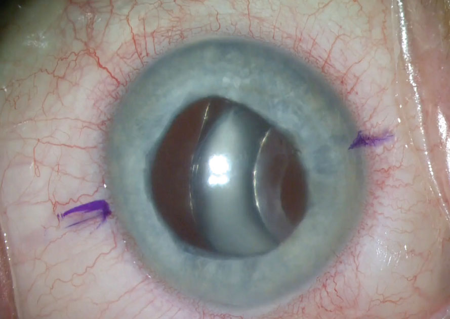 Figure 4. A subluxated one-piece acrylic PC IOL-capsular bag complex. One-piece acrylic lenses can be sutured if they’re still in the bag. The thick haptics on these lenses must be wrapped by the capsule to prevent chafing.