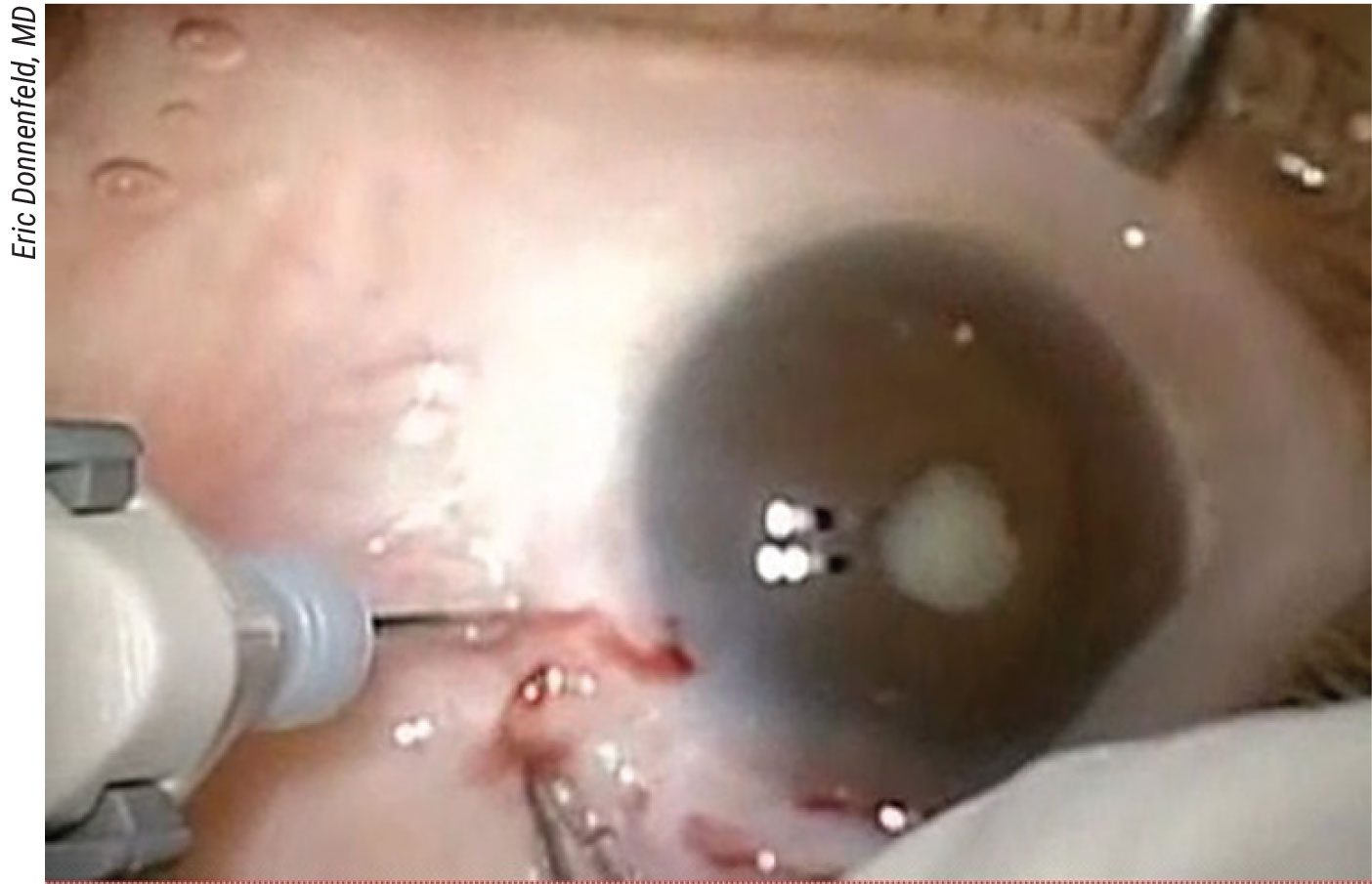 Figure 2. Patients with uveitis and glaucoma may have extremely small pupils and shallow anterior chambers. In the case shown above, a pars plana vitrectomy is needed to create anterior space to allow for removal of this patient’s Morgagnian cataract.