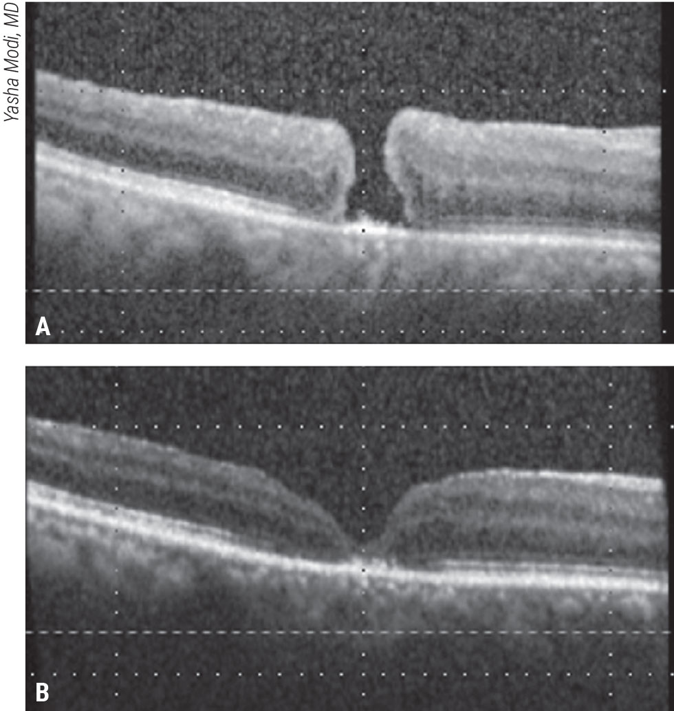 Figure 2. Macula detachment for a refractory macular hole. This patient presented with a visual acuity of 20/400 two weeks after failed initial macular hole surgery with ILM peeling (A). A macular detachment was induced, followed by fluid-air exchange and gas tamponade. The macular hole closed and vision improved to 20/150 (B).