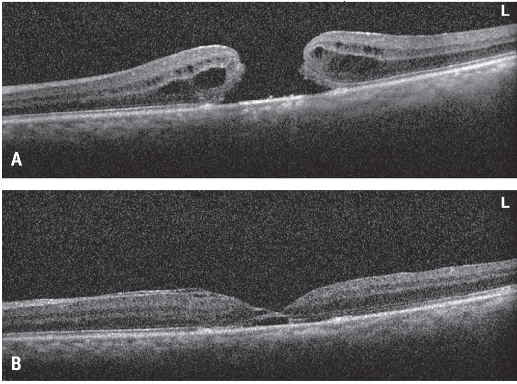 Figure 4. Inverted ILM flap for a large macular hole. This patient presented with a large macular hole and visual acuity of 20/200 (A). Vitrectomy, inverted ILM flap, fluid-air exchange and gas tamponade were performed. The patient’s macular hole closed and vision improved to 20/70 (B).