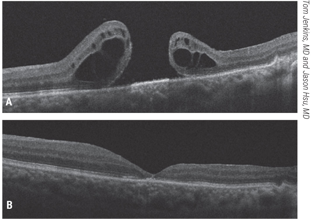 Figure 5. Free inner limiting membrane flap for a refractory, traumatic macular hole. A patient with a history of a traumatic macular hole who underwent vitrectomy, ILM peeling and gas tamponade presented with a refractory macular hole and 20/200 vision (A). He underwent ILM free flap placement into the macular hole, fluid-air exchange and gas tamponade. His macular hole closed and vision improved to 20/50 (B).