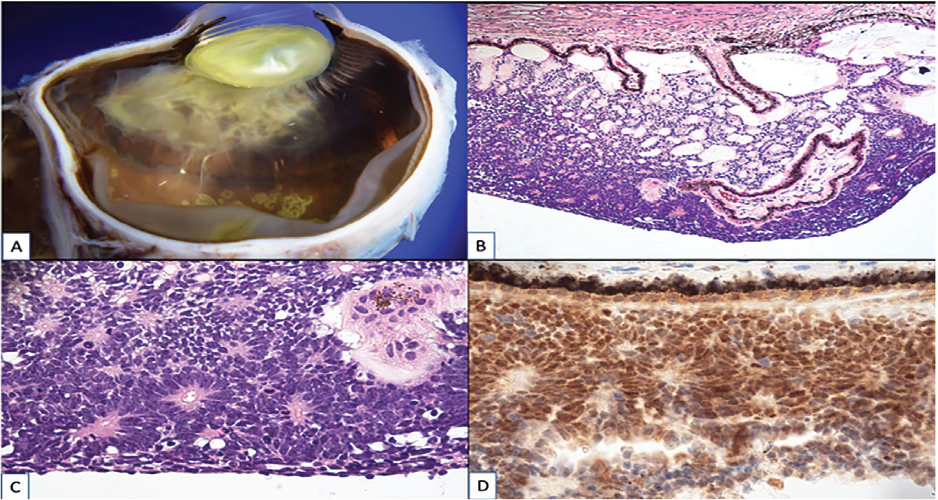 Figure 2. Pathology features: A) Gross dissection photograph showing a poorly circumscribed white to tan tumor covering the pars plicata and the anterior half of the pars plana of the ciliary body. B) Photomicrograph showing a basaloid tumor on the inner surface of the ciliary body. C) Photomicrograph showing mitotic figures and Flexner-Wintersteiner rosettes. D) Photomicrograph showing positive immunoreactivity for RB1 protein.