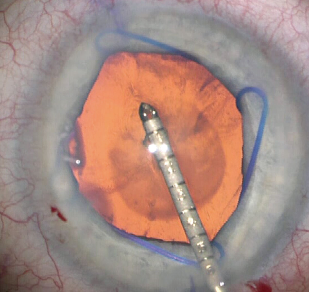 Series of cataract surgeries with I-ring pupil expansion ring