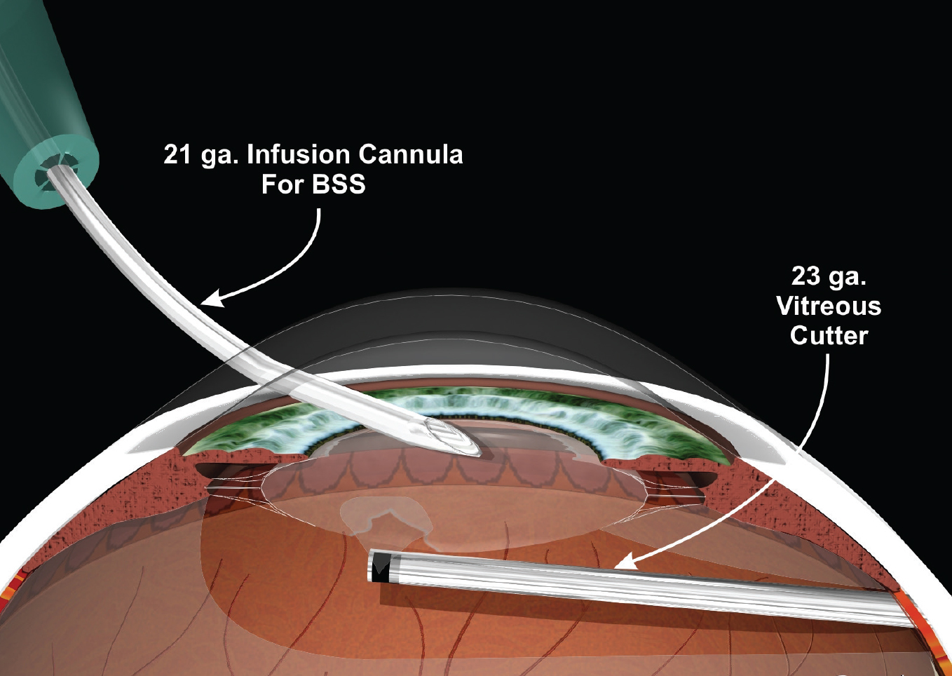 Analysis of capsular bag defects and intraocular lens positions for  consistent centration