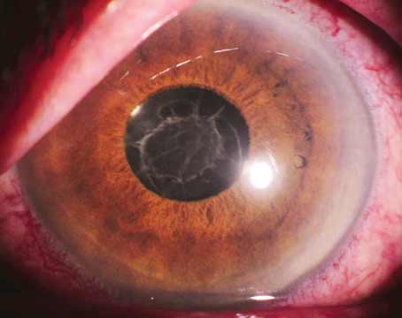 doctor visits after cataract surgery